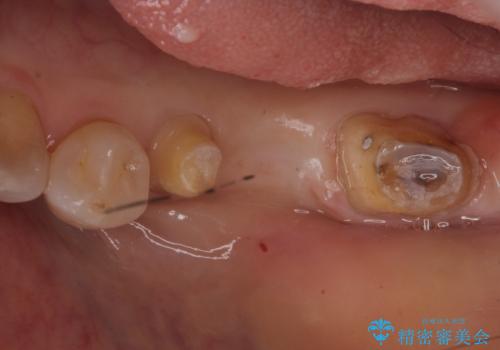 奥歯が割れた インプラントは不向き 部分矯正後、ブリッジで治療の治療中