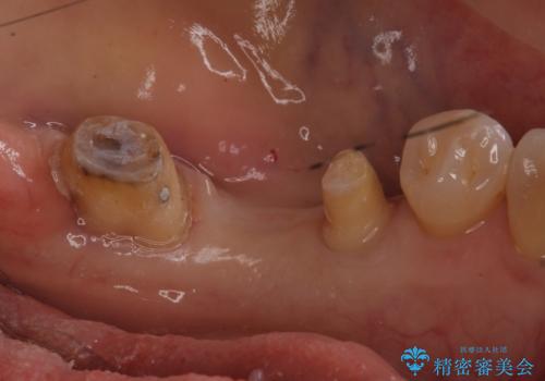 奥歯が割れた インプラントは不向き 部分矯正後、ブリッジで治療の治療中