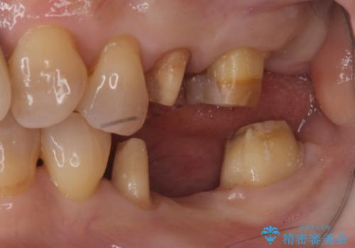 奥歯が割れた　インプラントは不向き　部分矯正後、ブリッジで治療の治療中