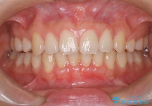 【歯肉退縮】歯茎の移植を行なった症例。の治療中