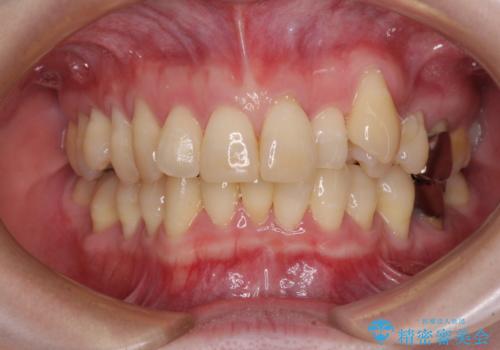 八重歯と先天欠損の歯列　ワイヤー矯正ですっきりとの症例 治療前