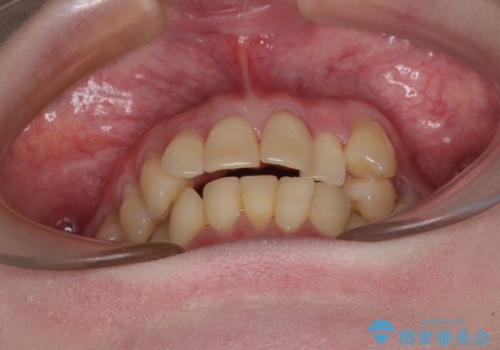 八重歯と先天欠損の歯列 ワイヤー矯正ですっきりとの治療前