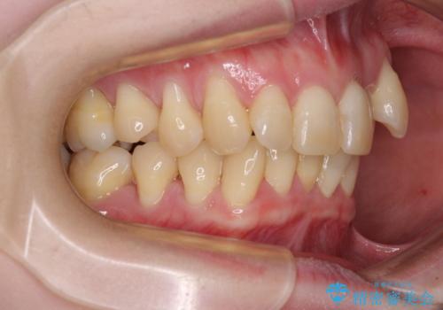 八重歯と先天欠損の歯列 ワイヤー矯正ですっきりとの治療前