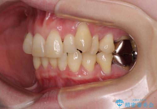 八重歯と先天欠損の歯列 ワイヤー矯正ですっきりとの治療前