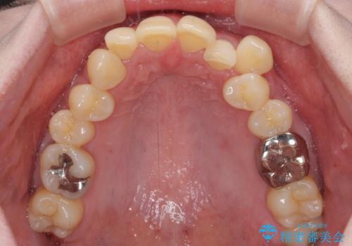 八重歯と先天欠損の歯列 ワイヤー矯正ですっきりとの治療前