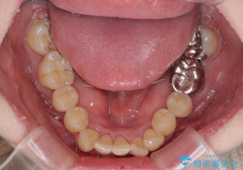 八重歯と先天欠損の歯列　ワイヤー矯正ですっきりとの治療前