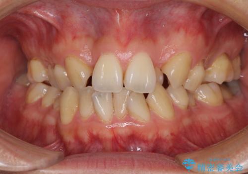 重なり合って磨きにくい前歯　ワイヤー装置での抜歯矯正の症例 治療前