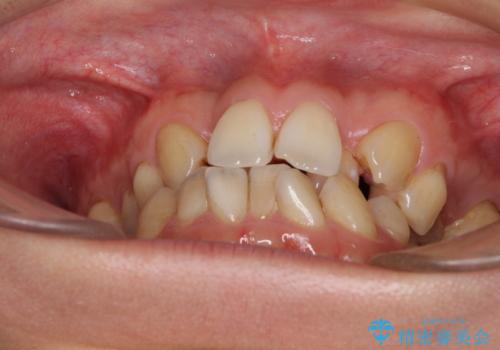 重なり合って磨きにくい前歯 ワイヤー装置での抜歯矯正の治療前