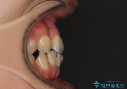 重なり合って磨きにくい前歯 ワイヤー装置での抜歯矯正の治療前