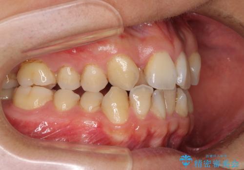 重なり合って磨きにくい前歯 ワイヤー装置での抜歯矯正の治療前