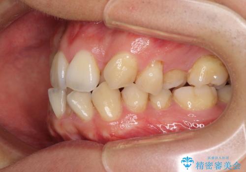 重なり合って磨きにくい前歯 ワイヤー装置での抜歯矯正の治療前