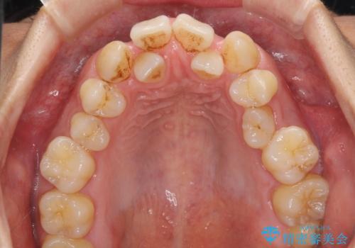 重なり合って磨きにくい前歯 ワイヤー装置での抜歯矯正の治療前