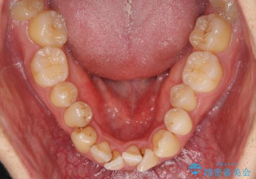 重なり合って磨きにくい前歯 ワイヤー装置での抜歯矯正の治療前