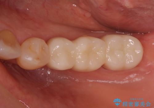 奥歯が割れた インプラントは不向き 部分矯正後、ブリッジで治療の治療後