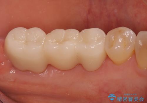 奥歯が割れた インプラントは不向き 部分矯正後、ブリッジで治療の治療後