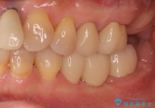 奥歯が割れた インプラントは不向き 部分矯正後、ブリッジで治療の治療後