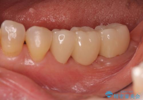 奥歯が割れた インプラントは不向き 部分矯正後、ブリッジで治療の治療後