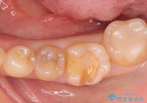 メタルインレーをセラミックインレーに。の治療中