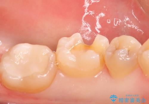 メタルインレーをセラミックインレーに。の治療中
