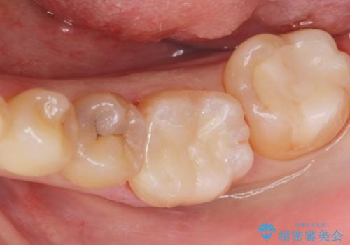 メタルインレーをセラミックインレーに。の治療後