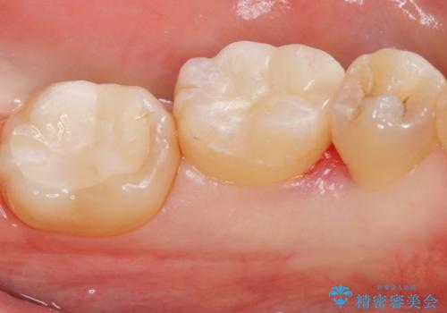 メタルインレーをセラミックインレーに。の治療後