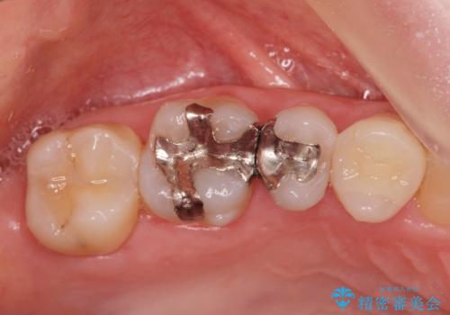 銀の詰め物がある2歯を白くしたい。の治療前