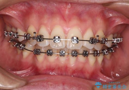 前歯のデコボコを抜歯矯正で改善　メタル装置で費用を抑えるの治療中