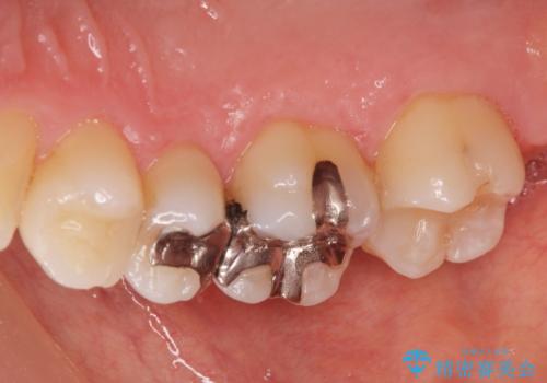 銀の詰め物がある2歯を白くしたい。の治療前