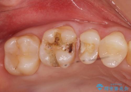 銀の詰め物がある2歯を白くしたい。の治療中