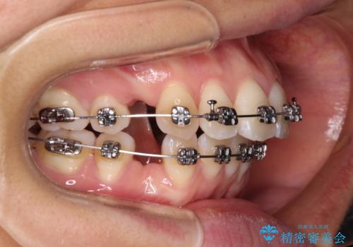 前歯のデコボコを抜歯矯正で改善 メタル装置で費用を抑えるの治療中