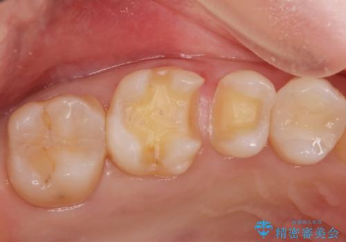 銀の詰め物がある2歯を白くしたい。の治療中