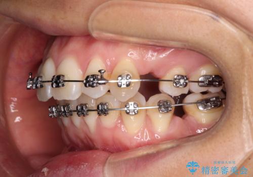 前歯のデコボコを抜歯矯正で改善 メタル装置で費用を抑えるの治療中