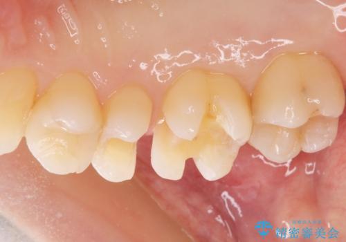 銀の詰め物がある2歯を白くしたい。の治療中