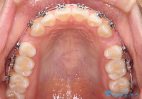 前歯のデコボコを抜歯矯正で改善 メタル装置で費用を抑えるの治療中