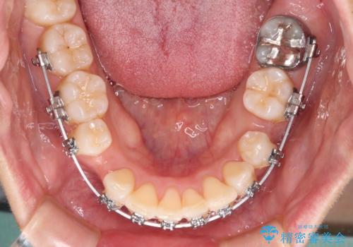 前歯のデコボコを抜歯矯正で改善 メタル装置で費用を抑えるの治療中