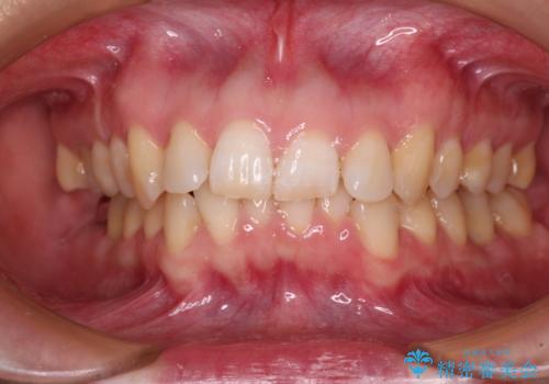 カリエール・ディスタライザーとインビザラインを用いた前歯の咬み合わせ改善の治療中