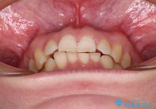 カリエール・ディスタライザーとインビザラインを用いた前歯の咬み合わせ改善の治療中