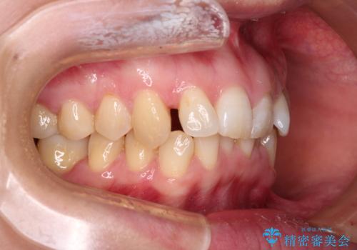 カリエール・ディスタライザーとインビザラインを用いた前歯の咬み合わせ改善の治療中