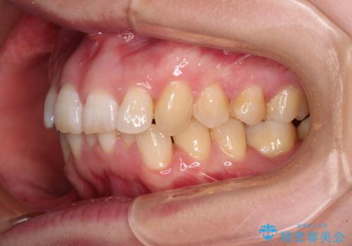 カリエール・ディスタライザーとインビザラインを用いた前歯の咬み合わせ改善の治療中