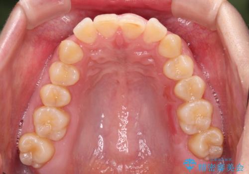 カリエール・ディスタライザーとインビザラインを用いた前歯の咬み合わせ改善の治療中