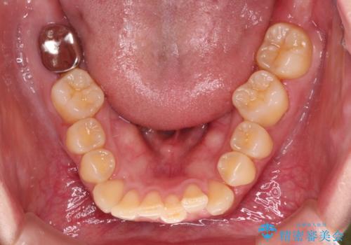 カリエール・ディスタライザーとインビザラインを用いた前歯の咬み合わせ改善の治療中