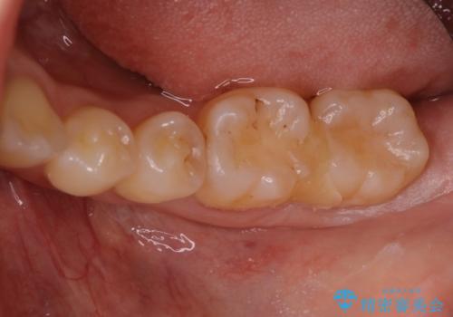 他院で虫歯と言われた。の治療前