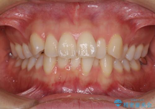 前歯のデコボコを抜歯矯正で改善　メタル装置で費用を抑えるの症例 治療前