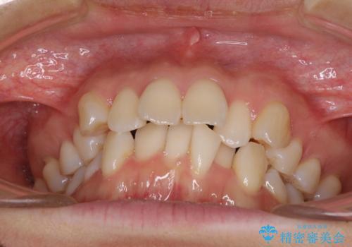 前歯のデコボコを抜歯矯正で改善 メタル装置で費用を抑えるの治療前