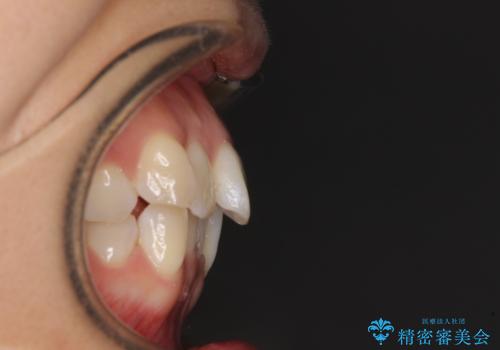 前歯のデコボコを抜歯矯正で改善 メタル装置で費用を抑えるの治療前