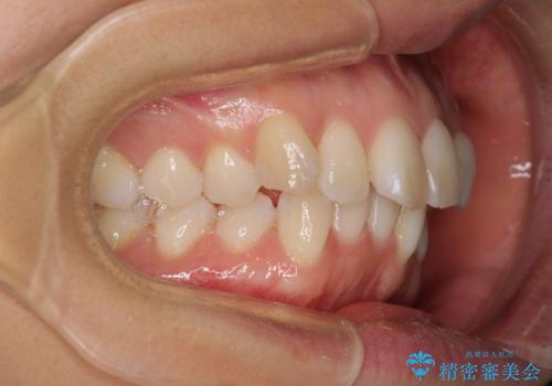 前歯のデコボコを抜歯矯正で改善　メタル装置で費用を抑えるの治療前