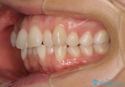 前歯のデコボコを抜歯矯正で改善 メタル装置で費用を抑えるの治療前