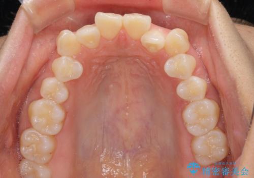 前歯のデコボコを抜歯矯正で改善 メタル装置で費用を抑えるの治療前
