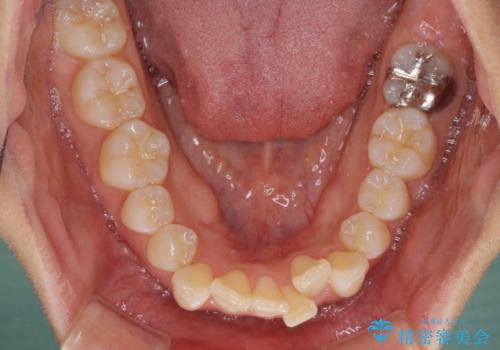 前歯のデコボコを抜歯矯正で改善　メタル装置で費用を抑えるの治療前