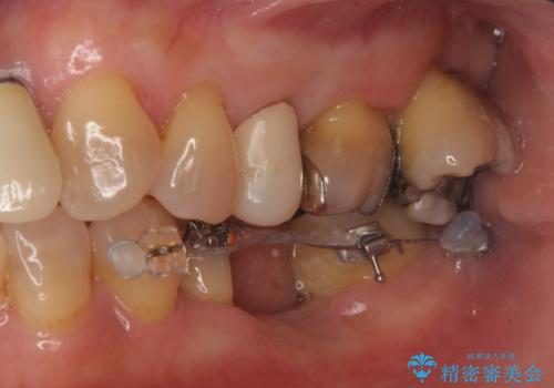 奥歯が割れた インプラントは不向き 部分矯正後、ブリッジで治療の治療中